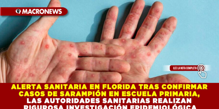 ALERTA SANITARIA EN FLORIDA TRAS CONFIRMAR CASOS DE SARAMPIÓN EN ESCUELA PRIMARIA, LAS AUTORIDADES SANITARIAS REALIZAN RIGUROSA INVESTIGACIÓN EPIDEMIOLÓGICA