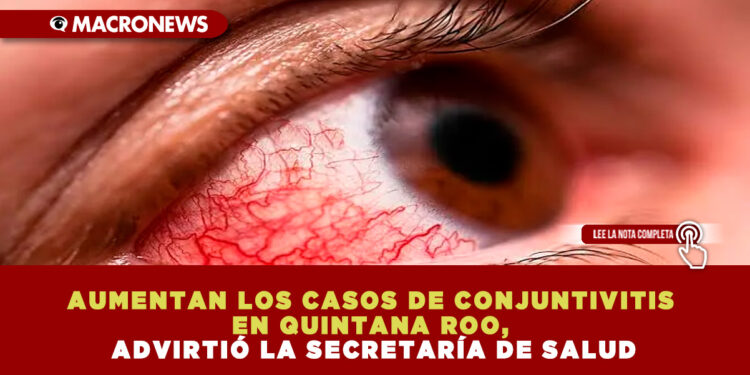 AUMENTAN LOS CASOS DE CONJUNTIVITIS EN QUINTANA ROO, ADVIRTIÓ LA SECRETARÍA DE SALUD