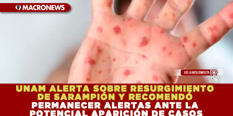 UNAM ALERTA SOBRE RESURGIMIENTO DE SARAMPIÓN Y RECOMENDÓ PERMANECER ALERTAS ANTE LA POTENCIAL APARICIÓN DE CASOS