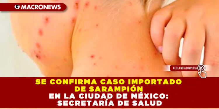 SE CONFIRMA CASO IMPORTADO DE SARAMPIÓN EN LA CIUDAD DE MÉXICO: SECRETARÍA DE SALUD