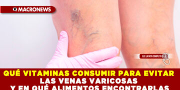 QUÉ VITAMINAS CONSUMIR PARA EVITAR LAS VENAS VARICOSAS Y EN QUÉ ALIMENTOS ENCONTRARLAS