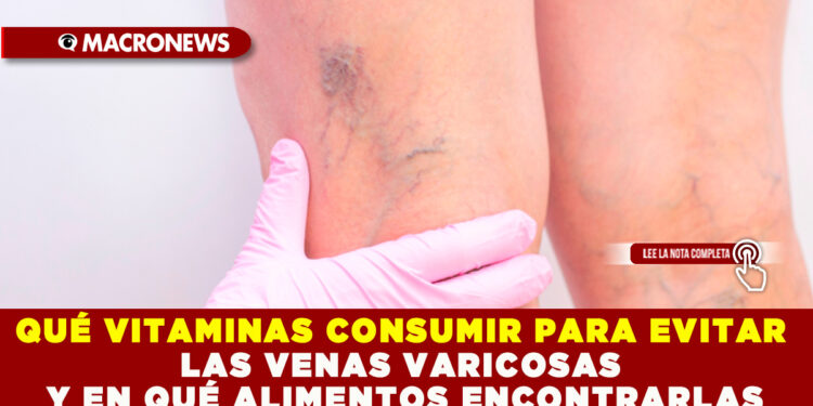QUÉ VITAMINAS CONSUMIR PARA EVITAR LAS VENAS VARICOSAS Y EN QUÉ ALIMENTOS ENCONTRARLAS