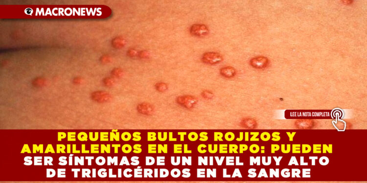 PEQUEÑOS BULTOS ROJIZOS Y AMARILLENTOS EN EL CUERPO: PUEDEN SER SÍNTOMAS DE UN NIVEL MUY ALTO DE TRIGLICÉRIDOS EN LA SANGRE