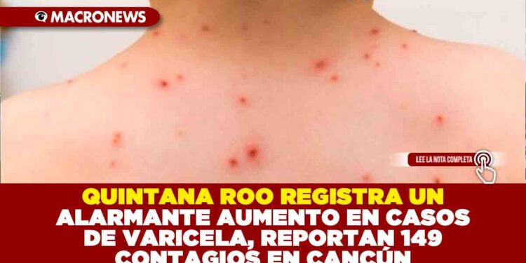 QUINTANA ROO REGISTRA UN ALARMANTE AUMENTO EN CASOS DE VARICELA, REPORTAN 149 CONTAGIOS EN CANCÚN