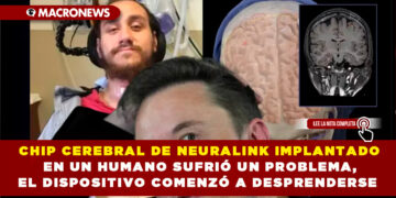 CHIP CEREBRAL DE NEURALINK IMPLANTADO EN UN HUMANO SUFRIÓ UN PROBLEMA, EL DISPOSITIVO COMENZÓ A DESPRENDERSE