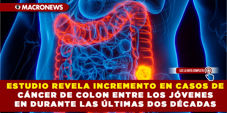 ESTUDIO REVELA INCREMENTO EN CASOS DE CÁNCER DE COLON ENTRE LOS JÓVENES EN DURANTE LAS ÚLTIMAS DOS DÉCADAS
