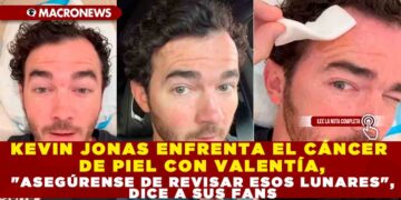 KEVIN JONAS ENFRENTA EL CÁNCER DE PIEL CON VALENTÍA, «ASEGÚRENSE DE REVISAR ESOS LUNARES», DICE A SUS FANS