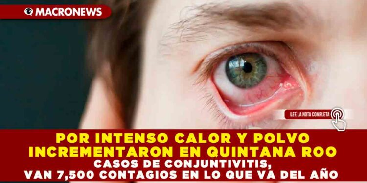 POR INTENSO CALOR Y POLVO INCREMENTARON EN QUINTANA ROO CASOS DE CONJUNTIVITIS, VAN 7,500 CONTAGIOS EN LO QUE VA DEL AÑO