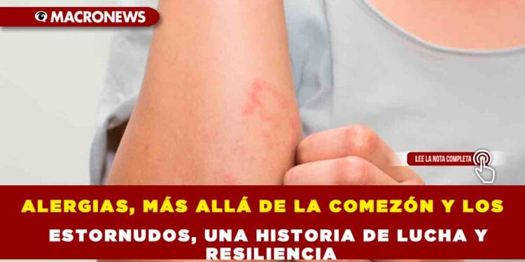 ALERGIAS, MÁS ALLÁ DE LA COMEZÓN Y LOS ESTORNUDOS, UNA HISTORIA DE LUCHA Y RESILIENCIA