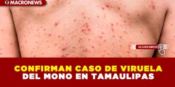 CONFIRMAN CASO DE VIRUELA DEL MONO EN TAMAULIPAS
