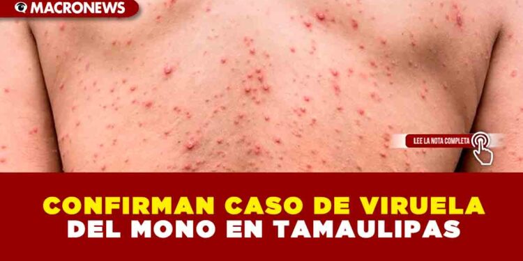 CONFIRMAN CASO DE VIRUELA DEL MONO EN TAMAULIPAS