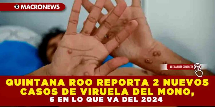 QUINTANA ROO REPORTA 2 NUEVOS CASOS DE VIRUELA DEL MONO, 6 EN LO QUE VA DEL 2024