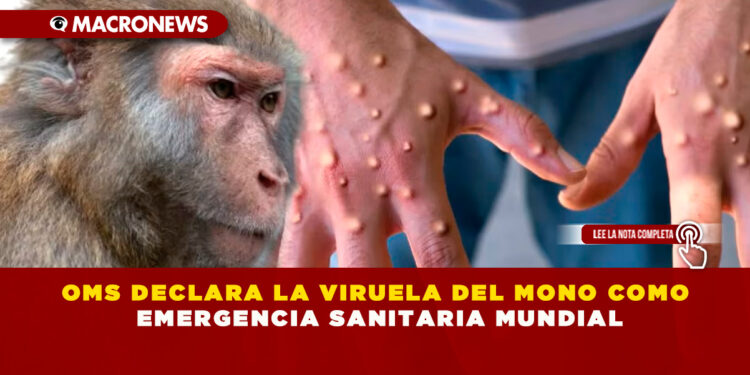 OMS DECLARA LA VIRUELA DEL MONO COMO EMERGENCIA SANITARIA MUNDIAL