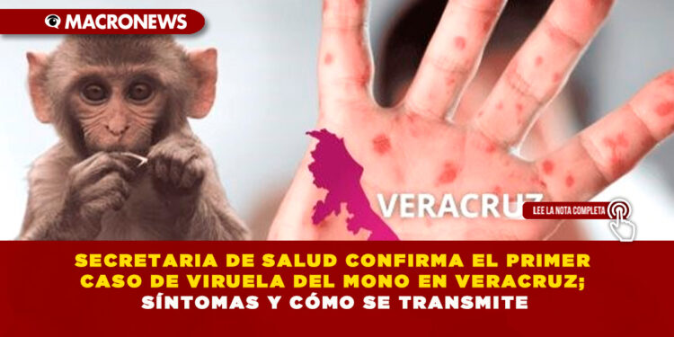 SECRETARIA DE SALUD CONFIRMA EL PRIMER CASO DE VIRUELA DEL MONO EN VERACRUZ; SÍNTOMAS Y CÓMO SE TRANSMITE