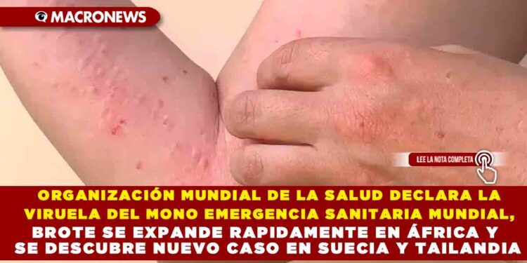 ORGANIZACIÓN MUNDIAL DE LA SALUD DECLARA LA VIRUELA DEL MONO  EMERGENCIA SANITARIA MUNDIAL, BROTE SE EXPANDE RAPIDAMENTE EN ÁFRICA Y SE DESCUBRE NUEVO CASO EN SUECIA Y TAILANDIA