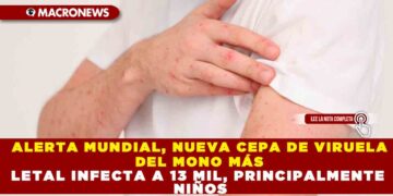 ALERTA MUNDIAL, NUEVA CEPA DE VIRUELA DEL MONO MÁS LETAL INFECTA A 13 MIL, PRINCIPALMENTE NIÑOS
