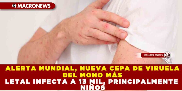 ALERTA MUNDIAL, NUEVA CEPA DE VIRUELA DEL MONO MÁS LETAL INFECTA A 13 MIL, PRINCIPALMENTE NIÑOS