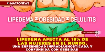 LIPEDEMA AFECTA AL 18% DE LAS MUJERES EN EL MUNDO, UNA ENFERMEDAD INFRADIAGNOSTICADA Y CONFUNDIDA CON OBESIDAD