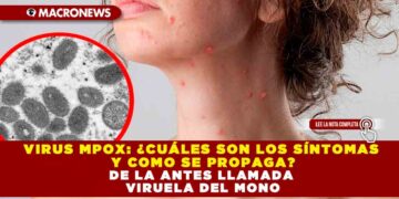 VIRUS MPOX: ¿CUÁLES SON LOS SÍNTOMAS Y COMO SE PROPAGA? DE LA ANTES LLAMADA VIRUELA DEL MONO