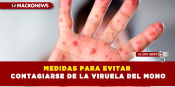 MEDIDAS PARA EVITAR CONTAGIARSE DE LA VIRUELA DEL MONO