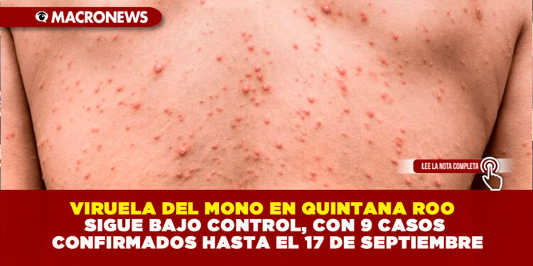 VIRUELA DEL MONO EN QUINTANA ROO SIGUE BAJO CONTROL, CON 9 CASOS CONFIRMADOS HASTA EL 17 DE SEPTIEMBRE