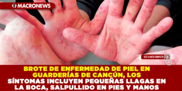 BROTE DE ENFERMEDAD DE PIEL EN GUARDERÍAS DE CANCÚN, LOS SÍNTOMAS INCLUYEN PEQUEÑAS LLAGAS EN LA BOCA, SALPULLIDO EN PIES Y MANOS 