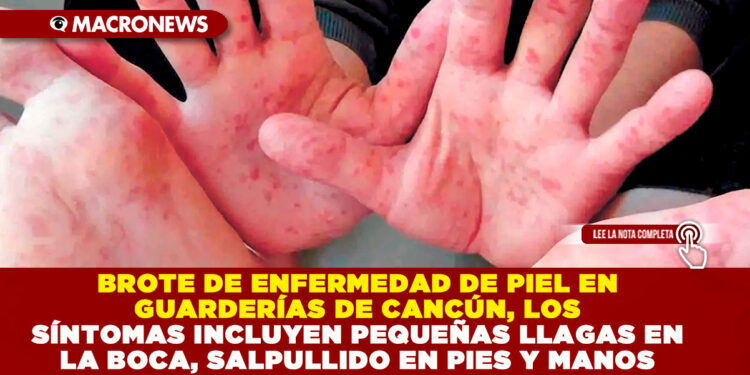 BROTE DE ENFERMEDAD DE PIEL EN GUARDERÍAS DE CANCÚN, LOS SÍNTOMAS INCLUYEN PEQUEÑAS LLAGAS EN LA BOCA, SALPULLIDO EN PIES Y MANOS 