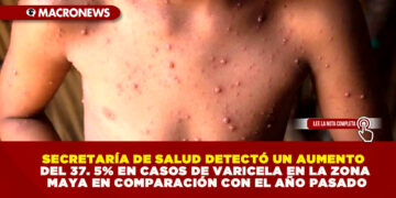 SECRETARÍA DE SALUD DETECTÓ UN AUMENTO DEL 37. 5% EN CASOS DE VARICELA EN LA ZONA MAYA EN COMPARACIÓN CON EL AÑO PASADO