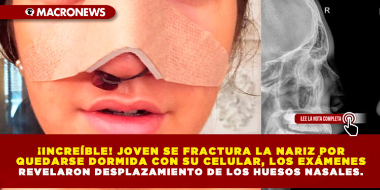 ¡INCREÍBLE! JOVEN SE FRACTURA LA NARIZ POR QUEDARSE DORMIDA CON SU CELULAR, LOS EXÁMENES REVELARON DESPLAZAMIENTO DE LOS HUESOS NASALES.