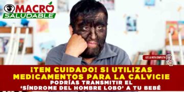 ¡TEN CUIDADO! SI UTILIZAS MEDICAMENTOS PARA LA CALVICIE PODRÍAS TRANSMITIR EL ‘SÍNDROME DEL HOMBRE LOBO’ A TU BEBÉ 