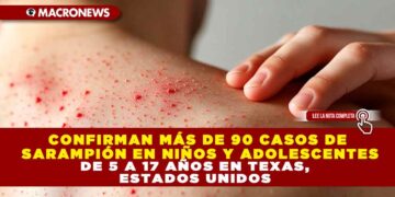 CONFIRMAN MÁS DE 90 CASOS DE SARAMPIÓN EN NIÑOS Y ADOLESCENTES DE 5 A 17 AÑOS EN TEXAS, ESTADOS UNIDOS