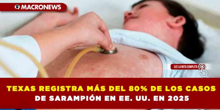TEXAS REGISTRA MÁS DEL 80% DE LOS CASOS DE SARAMPIÓN EN EE. UU. EN 2025