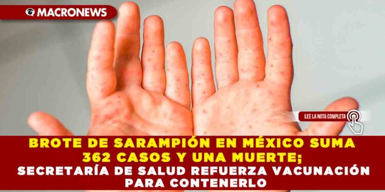 BROTE DE SARAMPIÓN EN MÉXICO SUMA 362 CASOS Y UNA MUERTE; SECRETARÍA DE SALUD REFUERZA VACUNACIÓN PARA CONTENERLO
