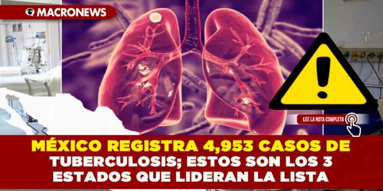 MÉXICO REGISTRA 4,953 CASOS DE TUBERCULOSIS; ESTOS SON LOS 3 ESTADOS QUE LIDERAN LA LISTA