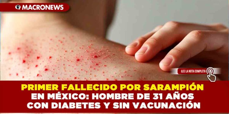 PRIMER FALLECIDO POR SARAMPIÓN EN MÉXICO: HOMBRE DE 31 AÑOS CON DIABETES Y SIN VACUNACIÓN