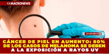 CÁNCER DE PIEL EN AUMENTO: 80% DE LOS CASOS DE MELANOMA SE DEBEN A LA EXPOSICIÓN A RAYOS UV
