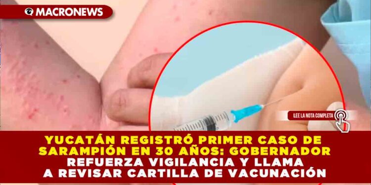 YUCATÁN REGISTRÓ PRIMER CASO DE SARAMPIÓN EN 30 AÑOS: GOBERNADOR REFUERZA VIGILANCIA Y LLAMA A REVISAR CARTILLA DE VACUNACIÓN