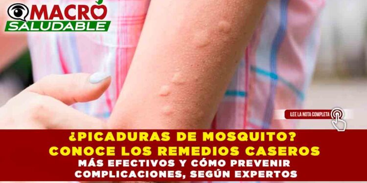 ¿PICADURAS DE MOSQUITO? CONOCE LOS REMEDIOS CASEROS MÁS EFECTIVOS Y CÓMO PREVENIR COMPLICACIONES, SEGÚN EXPERTOS