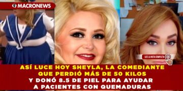 ASÍ LUCE HOY SHEYLA, LA COMEDIANTE QUE PERDIÓ MÁS DE 50 KILOS Y DONÓ 8.5 DE PIEL PARA AYUDAR A PACIENTES CON QUEMADURAS