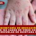 SECRETARÍA DE EDUCACIÓN REPORTO 165 CASOS DE VIRUS COXSACKIE EN ESCUELAS DE QUINTANA ROO