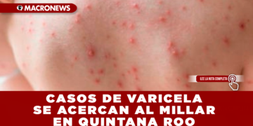 CASOS DE VARICELA SE ACERCAN AL MILLAR EN QUINTANA ROO; AUTORIDADES LLAMAN A REFORZAR LA VACUNACIÓN