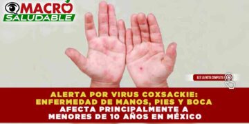 ALERTA POR VIRUS COXSACKIE: ENFERMEDAD DE MANOS, PIES Y BOCA AFECTA PRINCIPALMENTE A MENORES DE 10 AÑOS EN MÉXICO