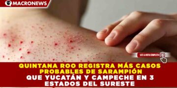 QUINTANA ROO REGISTRA MÁS CASOS  PROBABLES DE SARAMPIÓN  QUE YUCATÁN Y CAMPECHE EN 3  ESTADOS DEL SURESTE