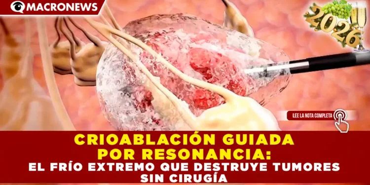 CRIOABLACIÓN GUIADA POR RESONANCIA: EL FRÍO EXTREMO QUE DESTRUYE TUMORES SIN CIRUGÍA