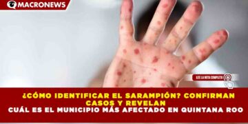 ¿CÓMO IDENTIFICAR EL SARAMPIÓN? CONFIRMAN  CASOS Y REVELAN CUÁL ES EL MUNICIPIO MÁS AFECTADO EN QUINTANA ROO