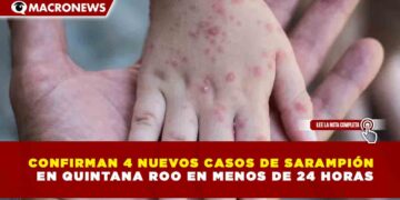 CONFIRMAN 4 NUEVOS CASOS DE SARAMPIÓN   EN QUINTANA ROO EN MENOS DE 24 HORAS