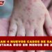 CONFIRMAN 4 NUEVOS CASOS DE SARAMPIÓN   EN QUINTANA ROO EN MENOS DE 24 HORAS