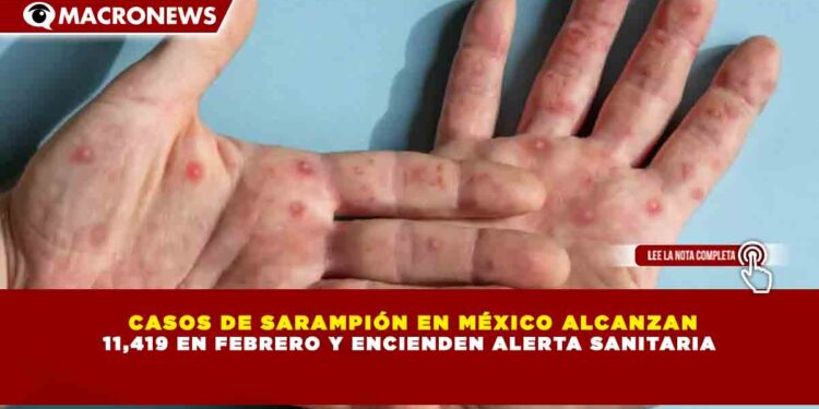 CASOS DE SARAMPIÓN EN MÉXICO ALCANZAN 11,419 EN FEBRERO Y ENCIENDEN ALERTA SANITARIA
