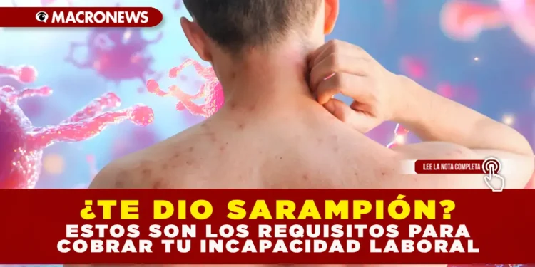 ¿TE DIO SARAMPIÓN? ESTOS SON LOS REQUISITOS PARA COBRAR TU INCAPACIDAD LABORAL