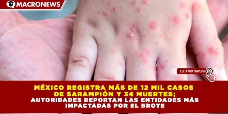 MÉXICO REGISTRA MÁS DE 12 MIL CASOS  DE SARAMPIÓN Y 34 MUERTES; AUTORIDADES REPORTAN LAS ENTIDADES MÁS  IMPACTADAS POR EL BROTE